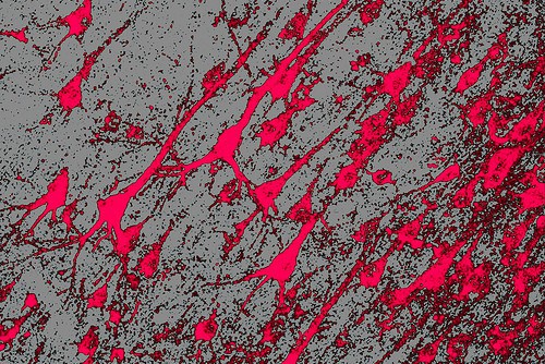 One and Done Gene Therapy