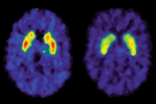 Reduced Dopamine D2 Receptors