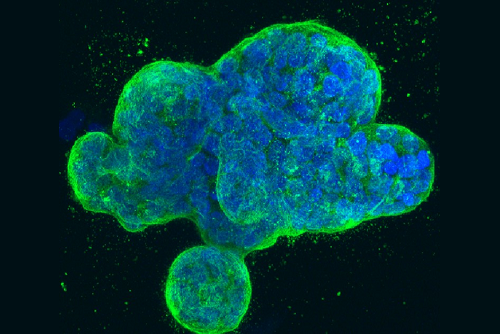 Breast Cancer in a Dish