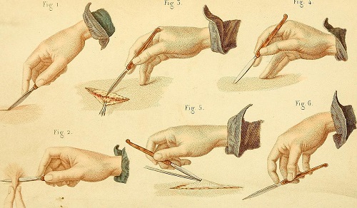 Illustration from A Text Book of Operative Surgery by Bernard, Huett, and Norton / Wikimedia Commons