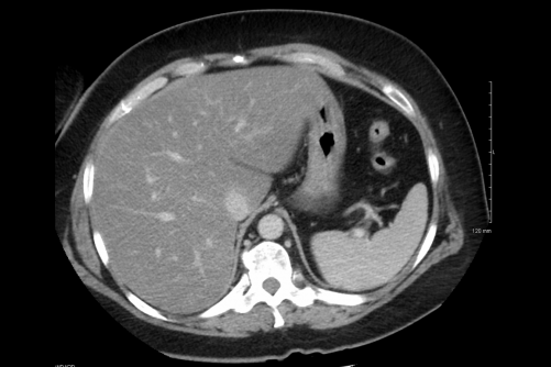 CT of Fatty Liver Disease