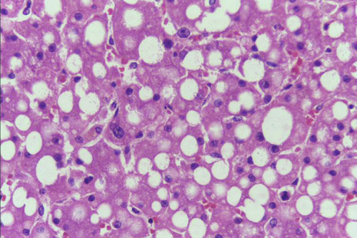 Hepatic Steatosis