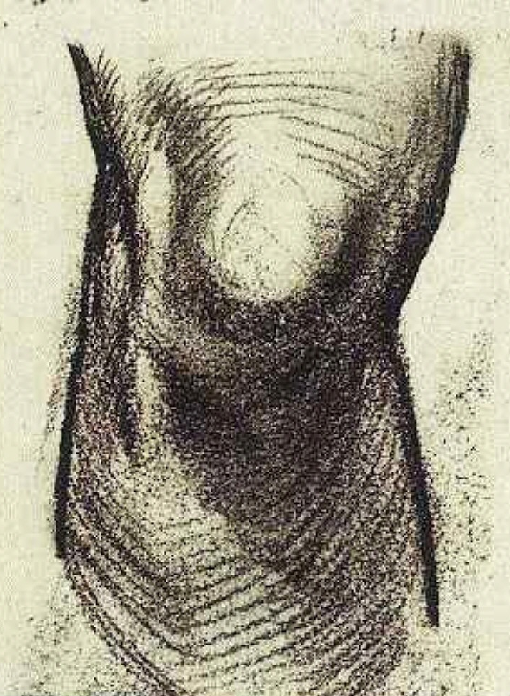 Need Knee Replacement? Bariatric Surgery Might Help