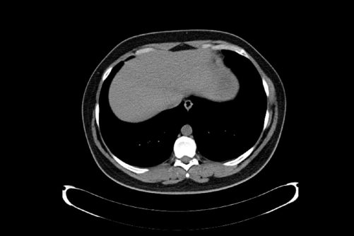 CT Scan of Thorax, Liver Window