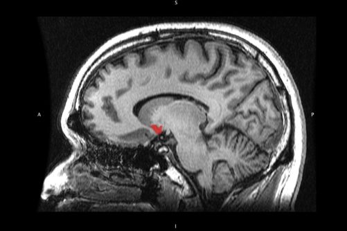 Nucleus Accumbens, magnetic resonance image by Geoff B. Hall / Wikimedia Commons