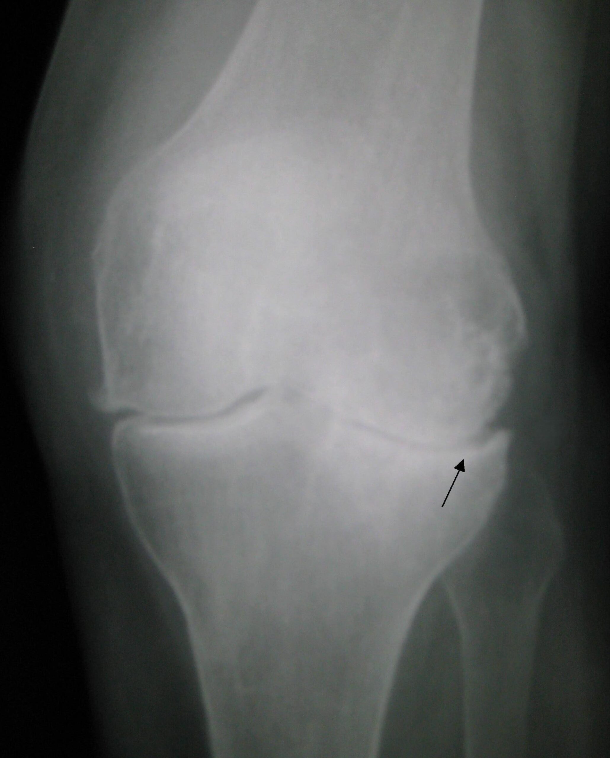 New Insight on How Semaglutide Helps with Osteoarthritis